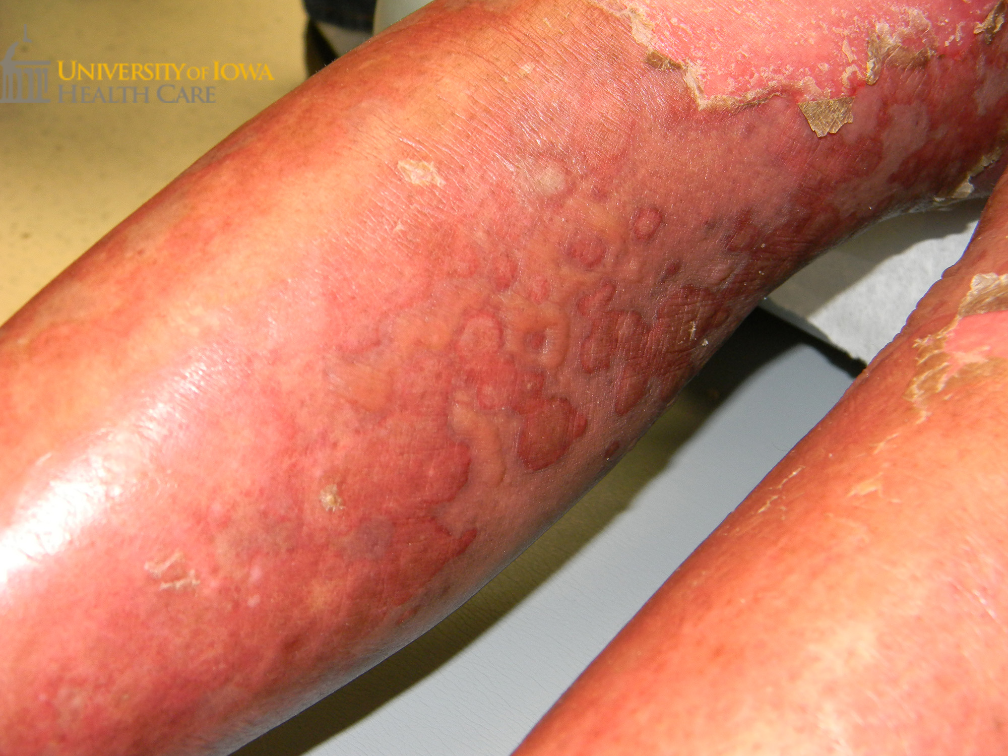 Flaccid bulla with surrounding erythema and focal area of superfical erosion and scaling on the leg. (click images for higher resolution).